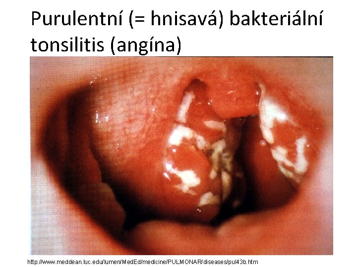 Purulentní (= hnisavá) bakteriální tonsilitis (angína) http: //www. meddean. luc. edu/lumen/Med. Ed/medicine/PULMONAR/diseases/pul 43 b.