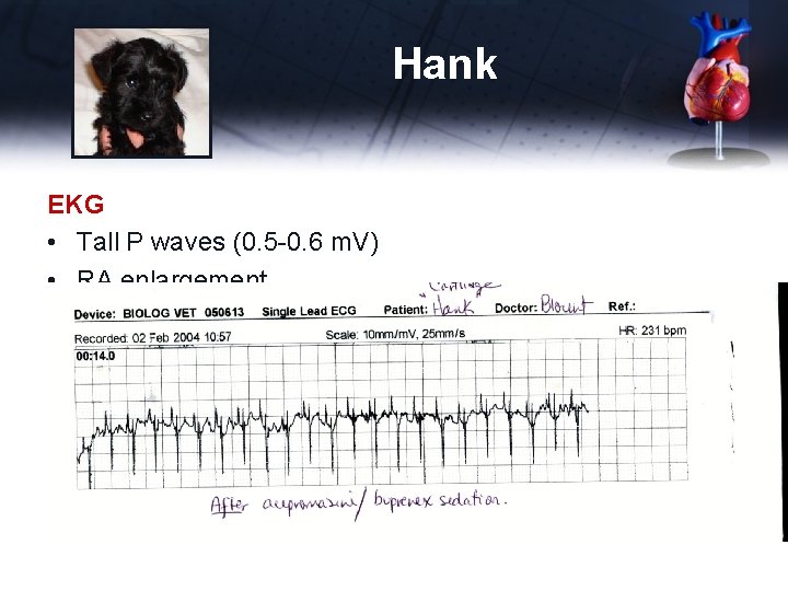 Hank EKG • Tall P waves (0. 5 -0. 6 m. V) • RA