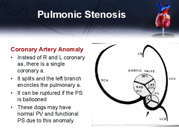 Pulmonic Stenosis Coronary Artery Anomaly • Instead of R and L coronary aa, there