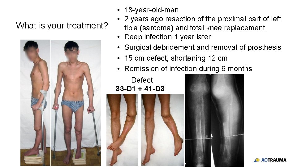 What is your treatment? • 18 -year-old-man • 2 years ago resection of the