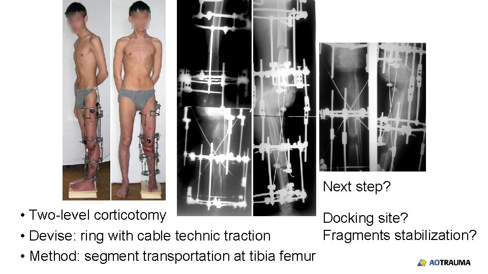 Next step? • Two-level corticotomy Docking site? Fragments stabilization? • Devise: ring with cable