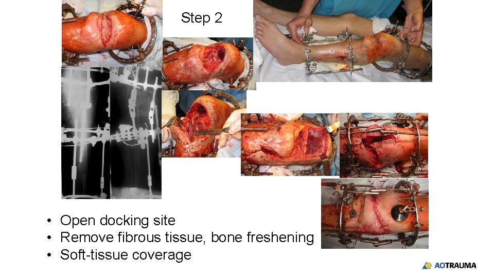 Step 2 • Open docking site • Remove fibrous tissue, bone freshening • Soft-tissue