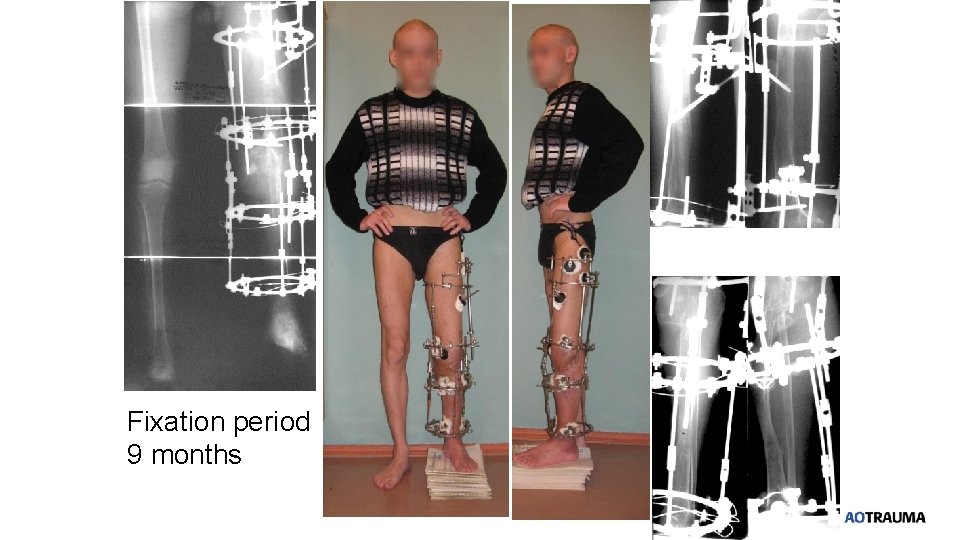 Fixation period 9 months 