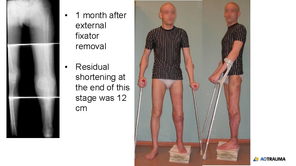  • 1 month after external fixator removal • Residual shortening at the end