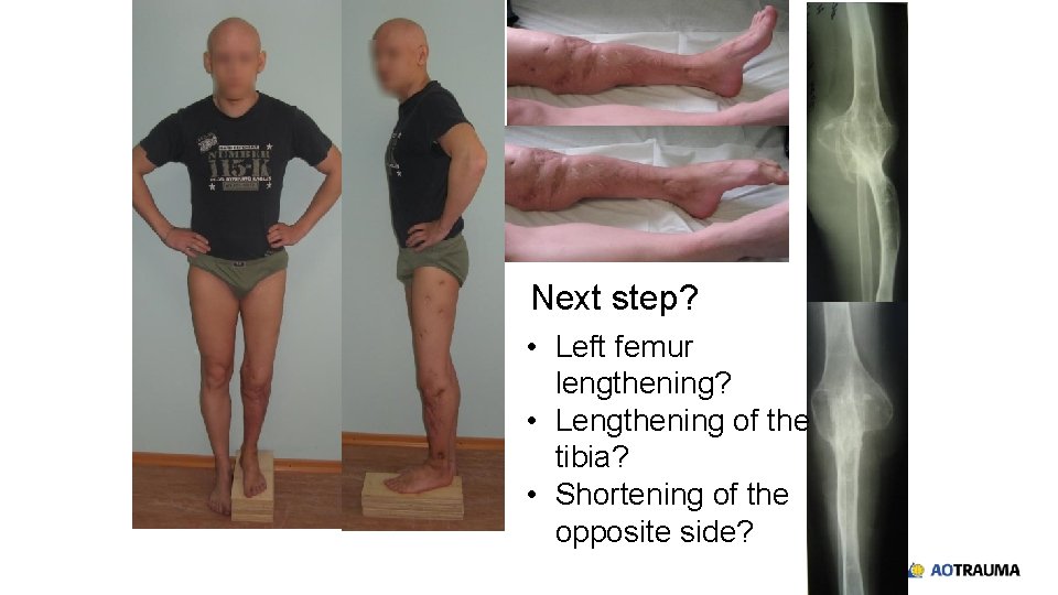 Next step? • Left femur lengthening? • Lengthening of the tibia? • Shortening of