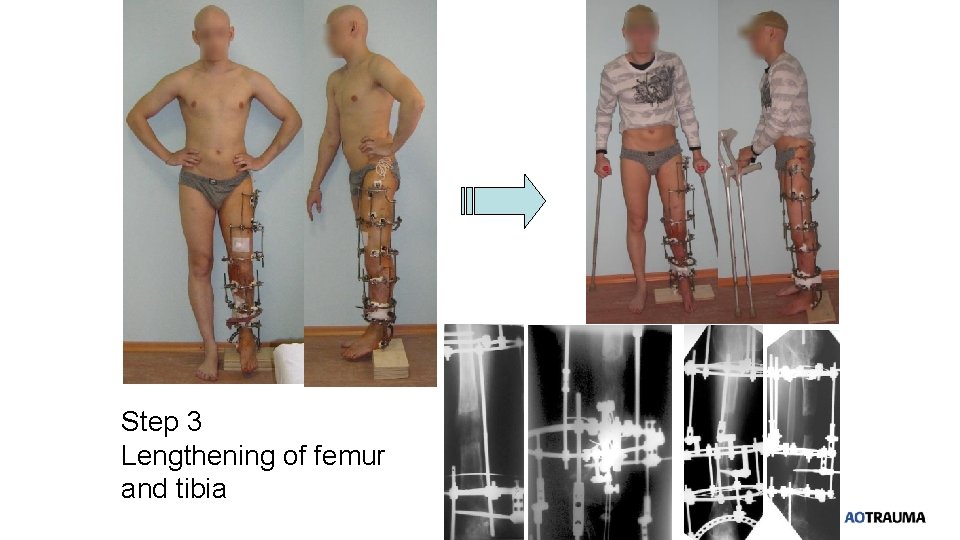 Step 3 Lengthening of femur and tibia 