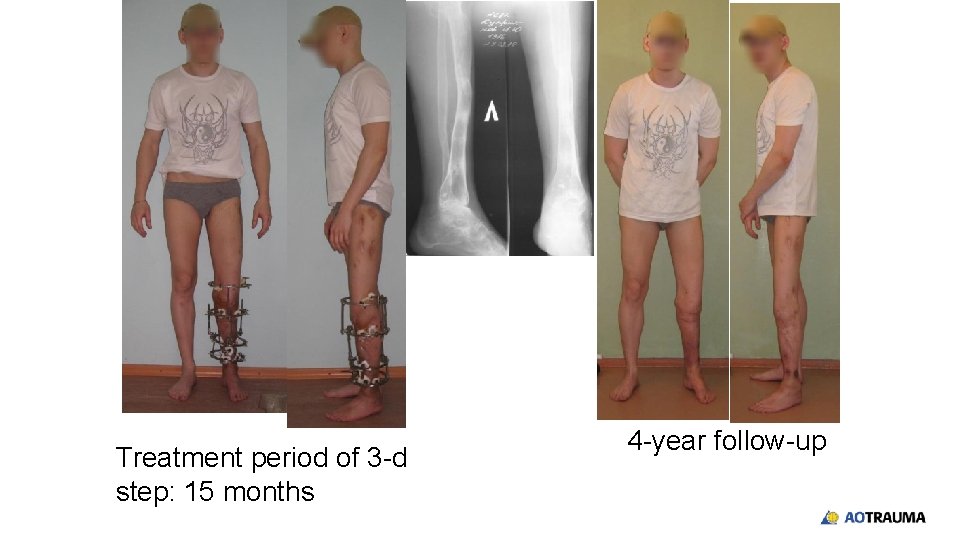Treatment period of 3 -d step: 15 months 4 -year follow-up 
