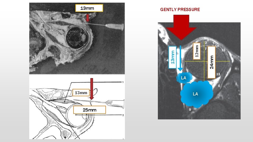 LA 13 mm 25 mm LA 24 mm 12 mm GENTLY PRESSURE 13 mmm