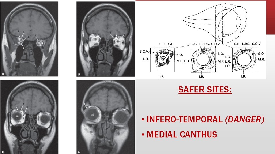SAFER SITES: ▪ INFERO-TEMPORAL (DANGER) ▪ MEDIAL CANTHUS 