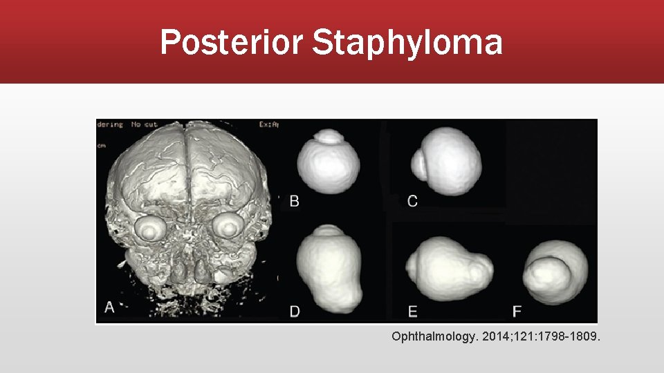 Posterior Staphyloma Ophthalmology. 2014; 121: 1798 -1809. 