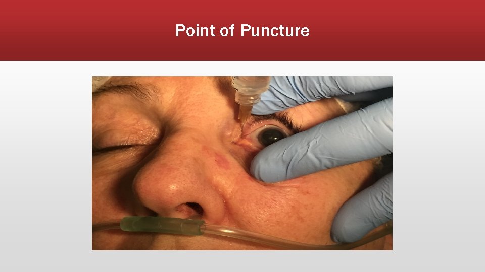 Point of Puncture 