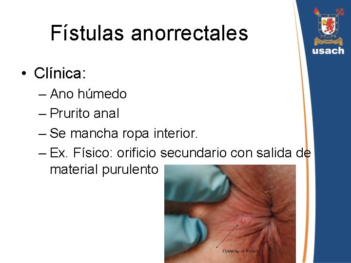 Fístulas anorrectales • Clínica: – Ano húmedo – Prurito anal – Se mancha ropa