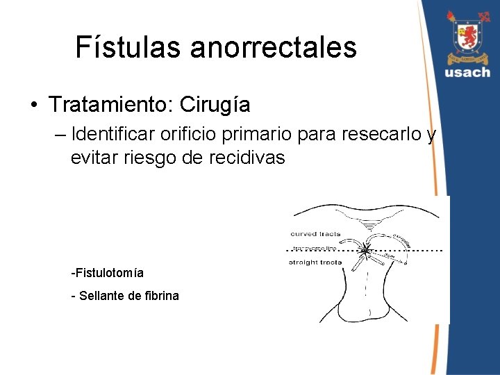 Fístulas anorrectales • Tratamiento: Cirugía – Identificar orificio primario para resecarlo y evitar riesgo