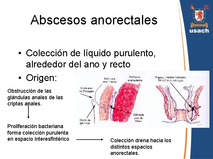 Abscesos anorectales • Colección de líquido purulento, alrededor del ano y recto • Origen: