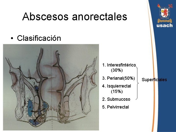 Abscesos anorectales • Clasificación 1. Interesfintérico (30%) 3. Perianal(50%) 4. Isquierrectal (15%) 2. Submucoso