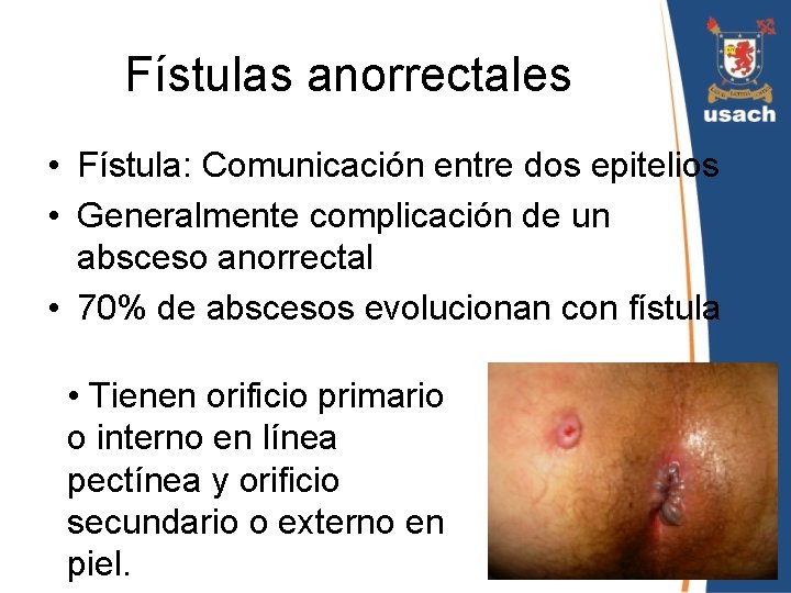 Fístulas anorrectales • Fístula: Comunicación entre dos epitelios • Generalmente complicación de un absceso