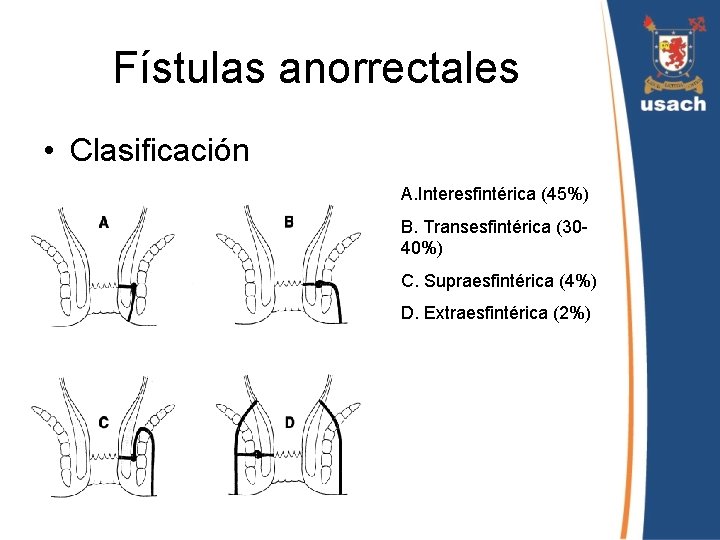 Fístulas anorrectales • Clasificación A. Interesfintérica (45%) B. Transesfintérica (3040%) C. Supraesfintérica (4%) D.