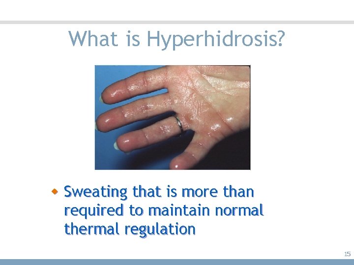 What is Hyperhidrosis? w Sweating that is more than required to maintain normal thermal