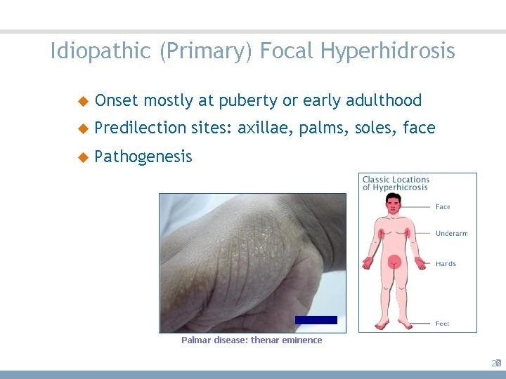 Idiopathic (Primary) Focal Hyperhidrosis 20 