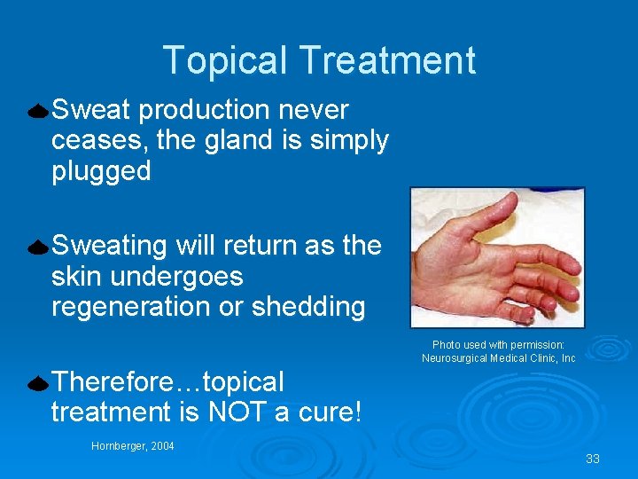 Topical Treatment Sweat production never ceases, the gland is simply plugged Sweating will return