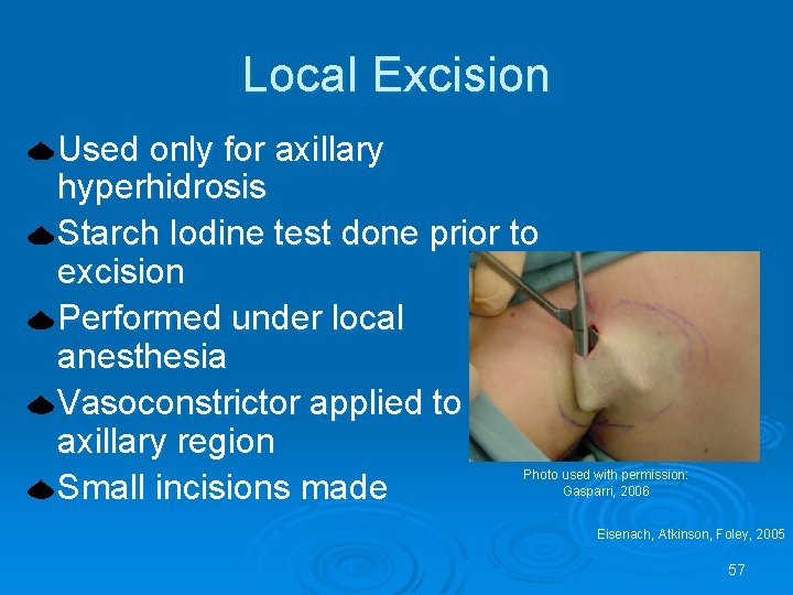 Local Excision Used only for axillary hyperhidrosis Starch Iodine test done prior to excision