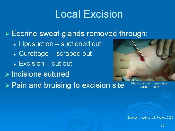 Local Excision Ø Eccrine sweat glands removed through: l l l Liposuction – suctioned