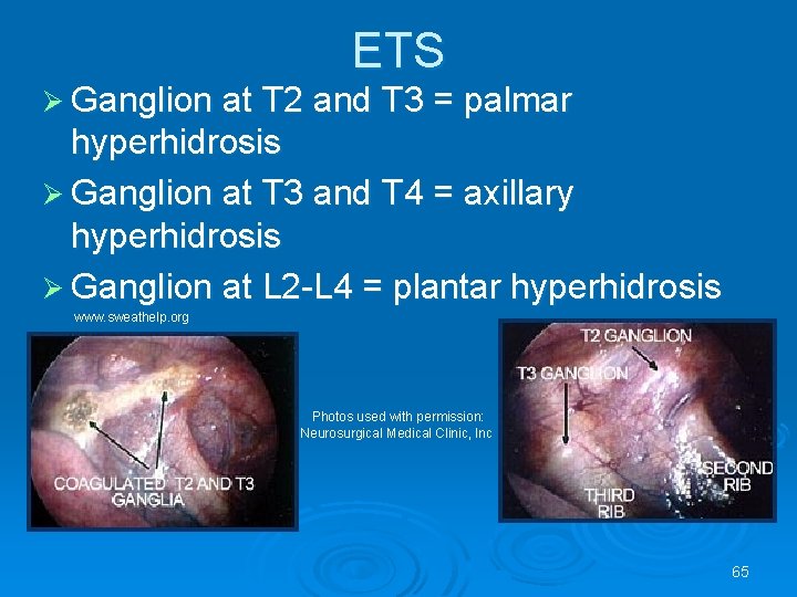 ETS Ø Ganglion at T 2 and T 3 = palmar hyperhidrosis Ø Ganglion