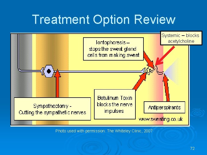 Treatment Option Review Systemic – blocks acetylcholine Photo used with permission: The Whiteley Clinic,