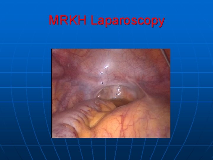 MRKH Laparoscopy 
