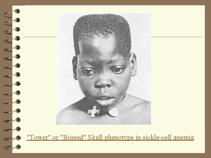 "Tower" or "Bossed" Skull phenotype in sickle-cell anemia 