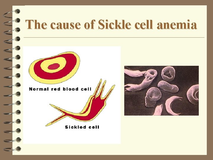 The cause of Sickle cell anemia 