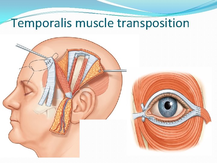 Temporalis muscle transposition 