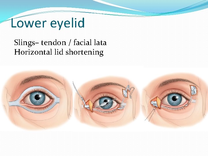 Lower eyelid Slings– tendon / facial lata Horizontal lid shortening 