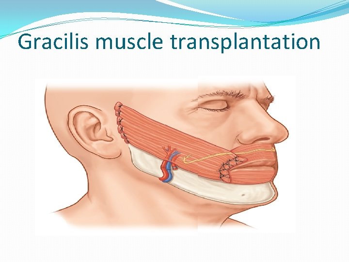 Gracilis muscle transplantation 