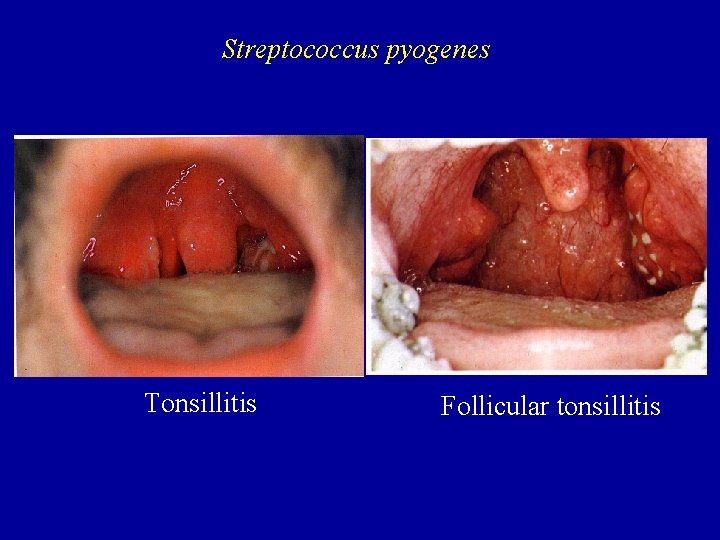 Streptococcus pyogenes Tonsillitis Follicular tonsillitis 