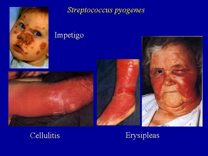 Streptococcus pyogenes Impetigo Cellulitis Erysipleas 