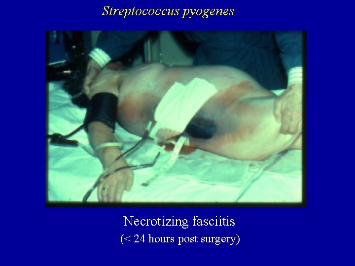 Streptococcus pyogenes Necrotizing fasciitis (< 24 hours post surgery) 