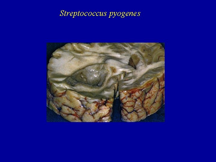 Streptococcus pyogenes 