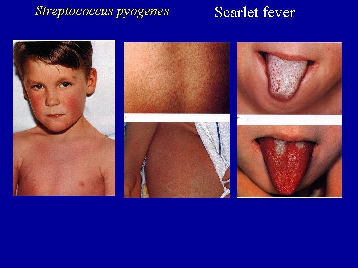 Streptococcus pyogenes Scarlet fever 