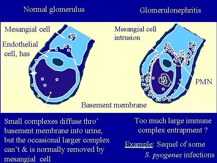 Normal glomerulus Glomerulonephritis Mesangial cell intrusion Mesangial cell Endothelial cell, has 100 nm pores