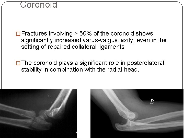 Coronoid � Fractures involving > 50% of the coronoid shows significantly increased varus-valgus laxity,