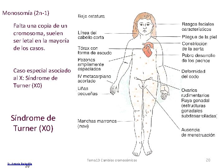 Monosomía (2 n-1) Falta una copia de un cromosoma, suelen ser letal en la