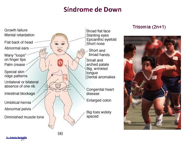 Síndrome de Down Trisomía (2 n+1) 21 Dr. Antonio Barbadilla 21 Tema 13 Cambios