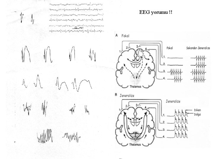 EEG yorumu !! 