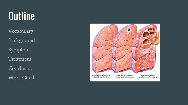 Outline Vocabulary Background Symptoms Treatment Conclusion Work Cited 