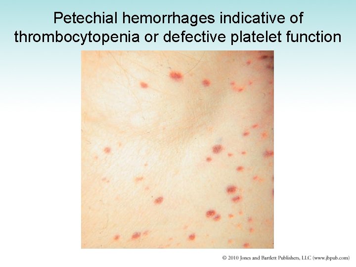 Petechial hemorrhages indicative of thrombocytopenia or defective platelet function 