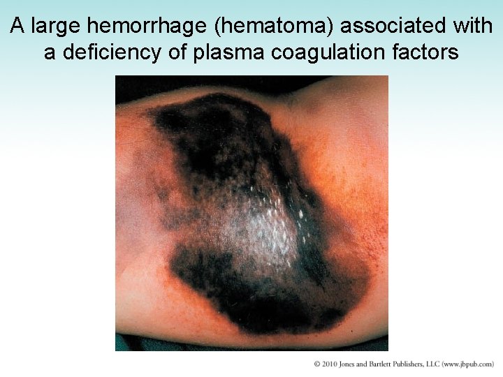 A large hemorrhage (hematoma) associated with a deficiency of plasma coagulation factors 