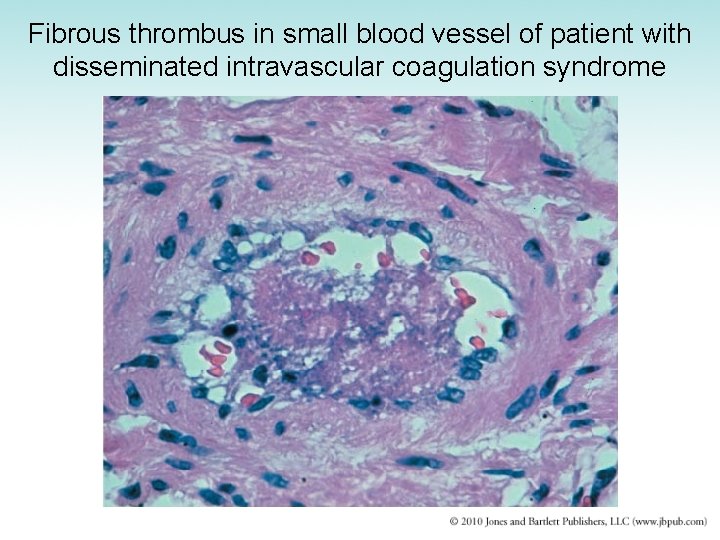 Fibrous thrombus in small blood vessel of patient with disseminated intravascular coagulation syndrome 