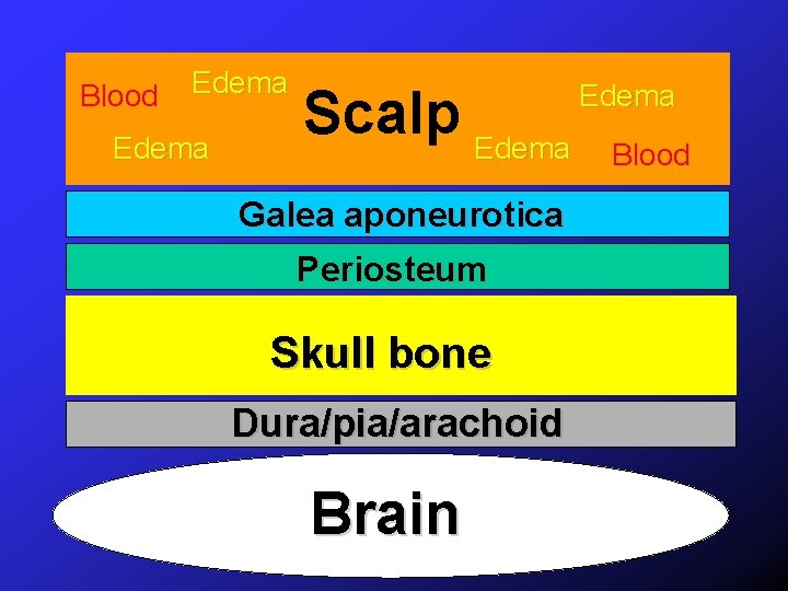 Blood Edema Scalp Edema Galea aponeurotica Periosteum Skull bone Dura/pia/arachoid Brain Edema Blood 