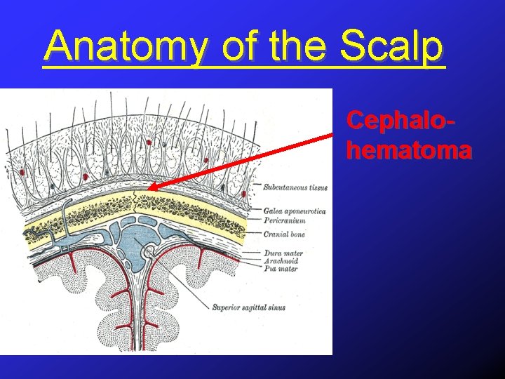 Anatomy of the Scalp Cephalohematoma 
